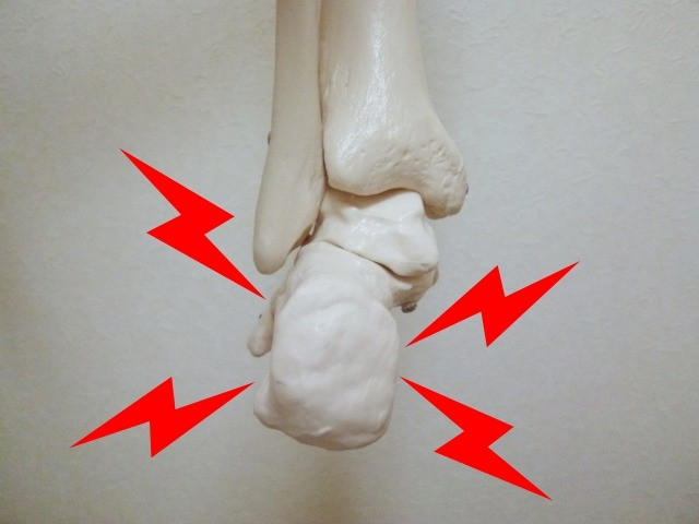 ［踵の痛み］踵骨骨端症（シーバー病）｜しげの鍼灸院・接骨院